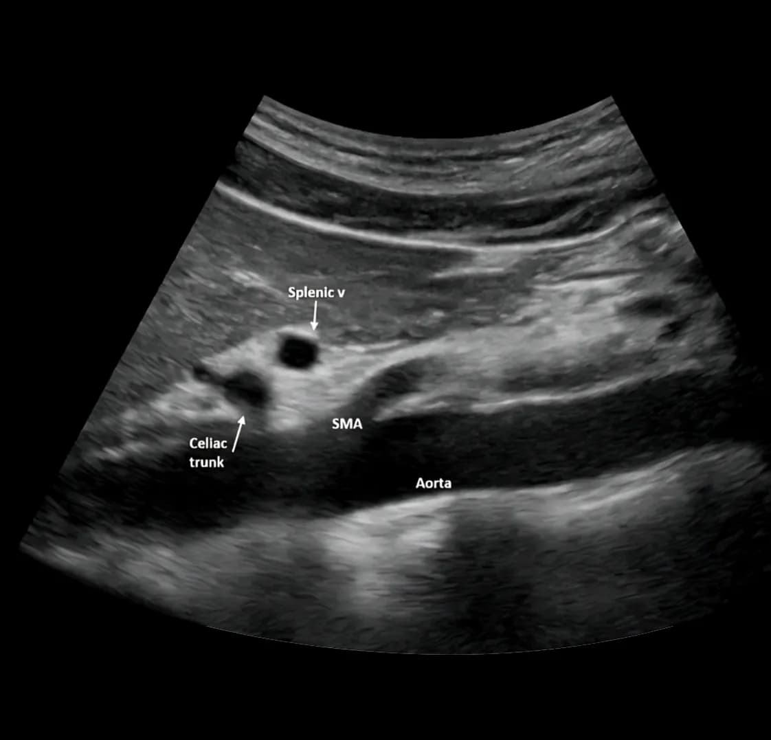 Aortic Surveillance (AAA Screening)