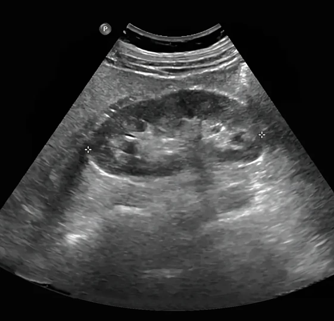 Kidney Ultrasound Scan