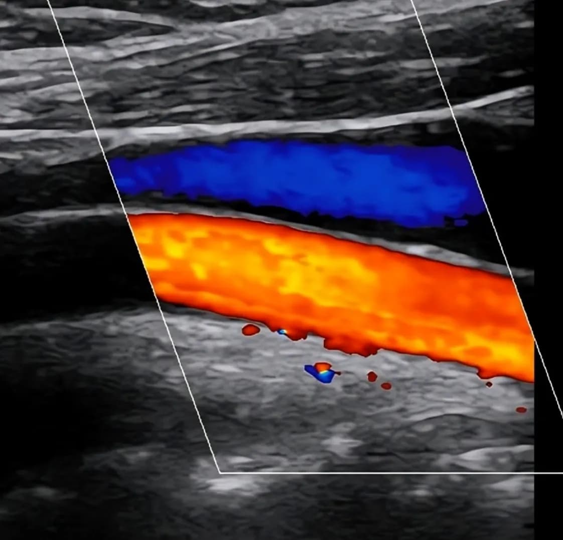Deep Vein Thrombosis (DVT) Scan