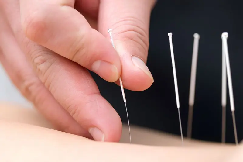 Acupuncture