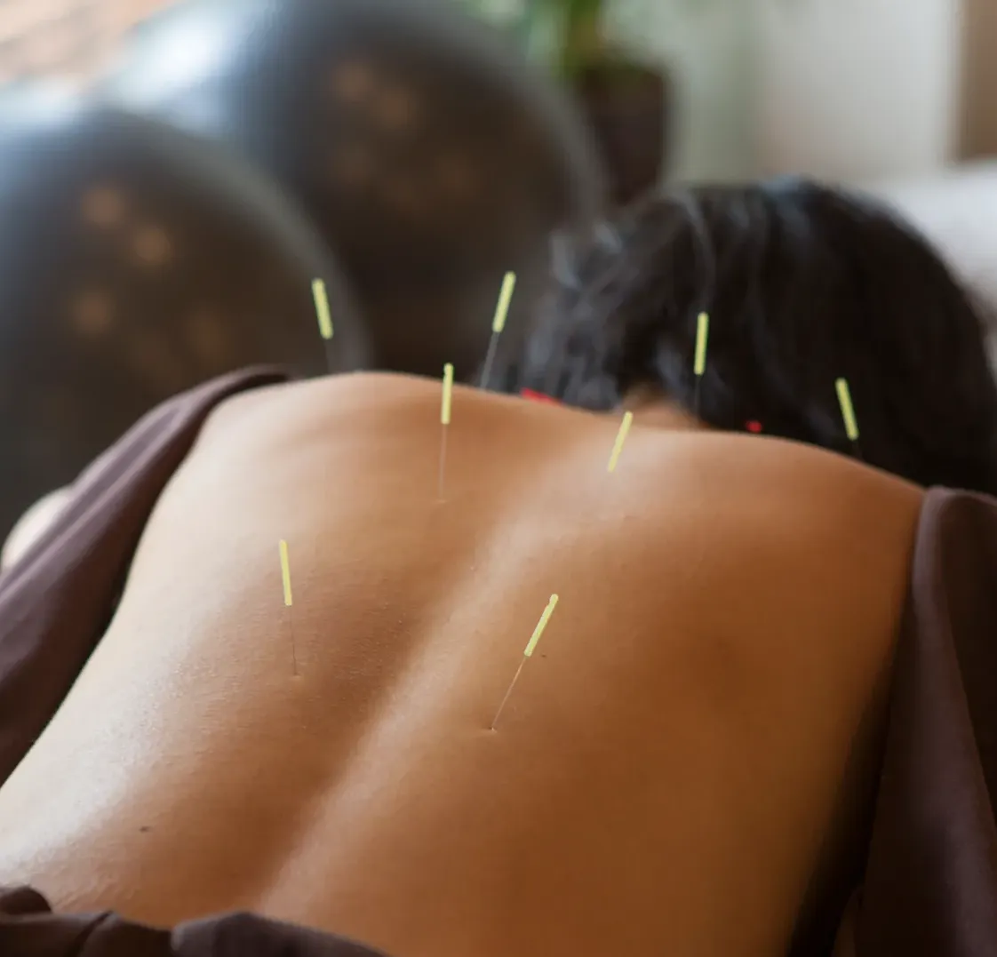 Acupuncture