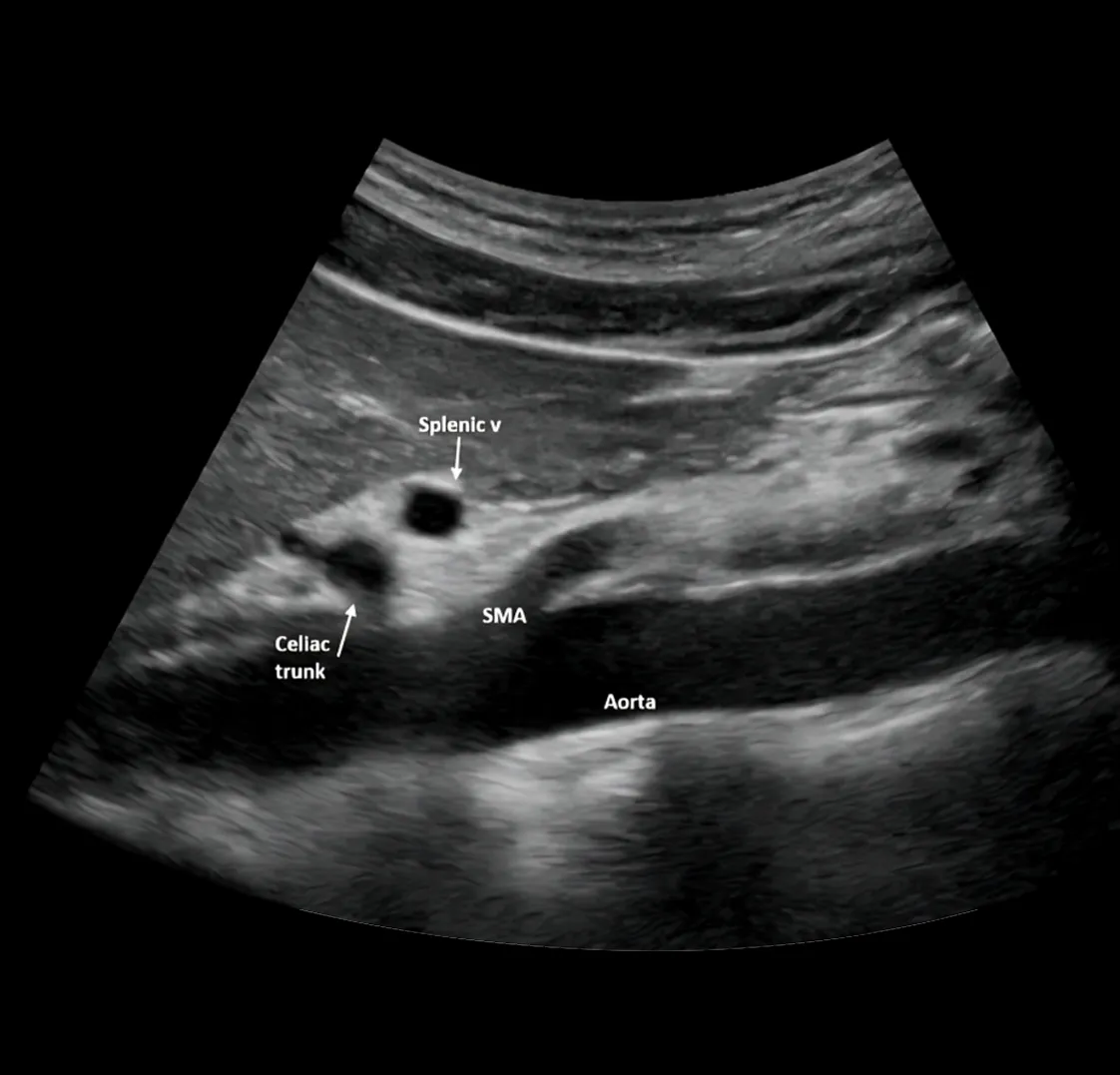 Aortic Surveillance (AAA Screening) Scan
