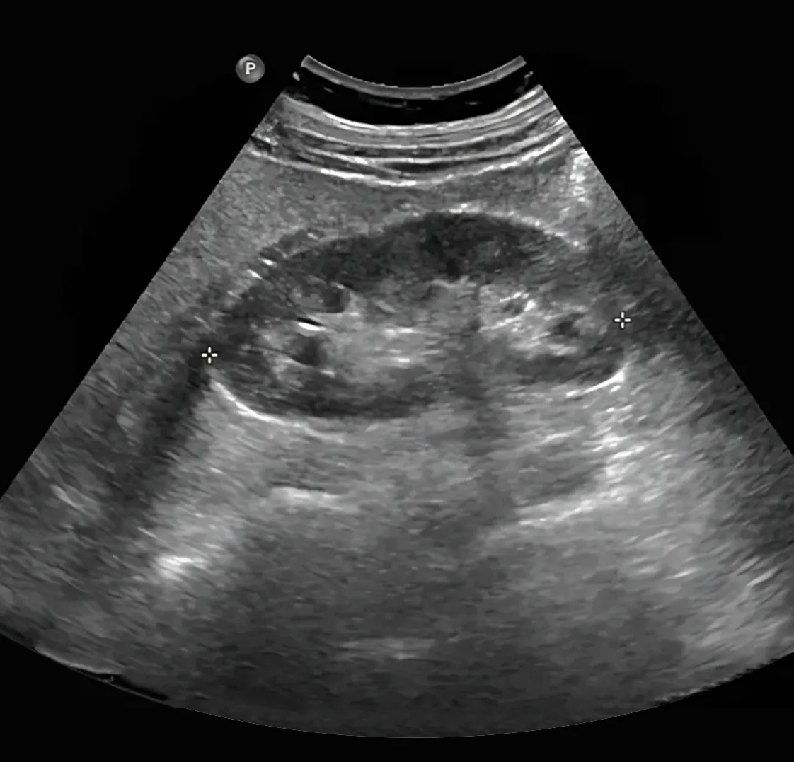 Renal (Kidneys) Ultrasound Scan